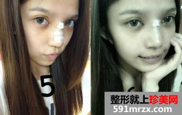 北京,华韩,整形,医院,余恩旭,开内眼角,前后,对比图