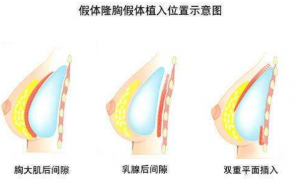 假体隆胸术后注意事项有哪些