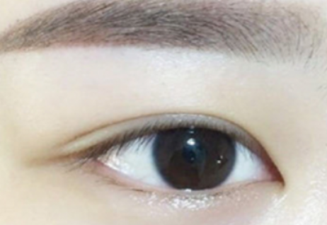 眼袋提中面部术能维持多久