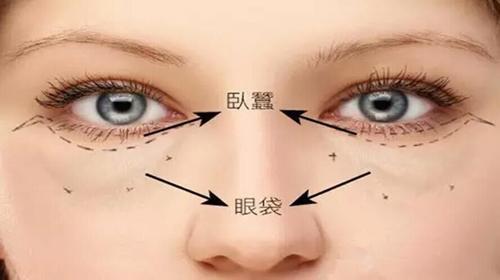 天生就有眼袋比较严重怎么办