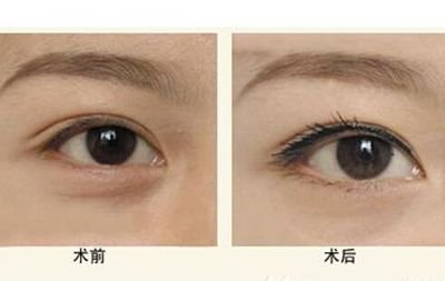哪里眼袋做得好