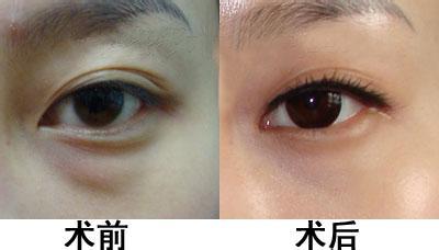 哪里眼袋做得好
