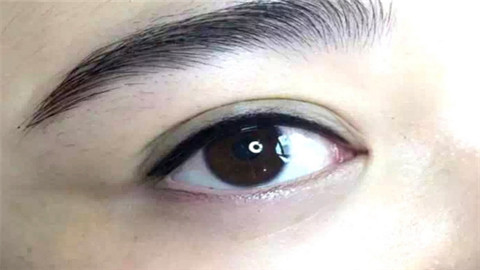 抽脂去眼袋能维持几年