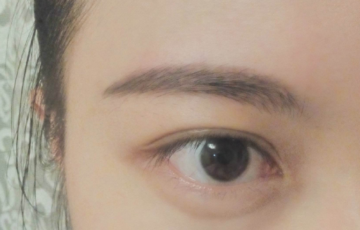 切除眼袋风险