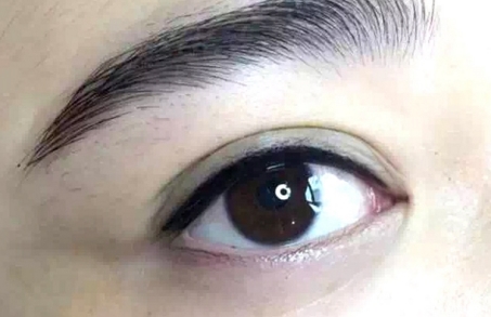眼袋切除术有风险吗