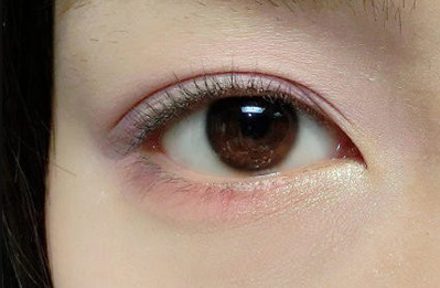 眼袋整形一次多少钱