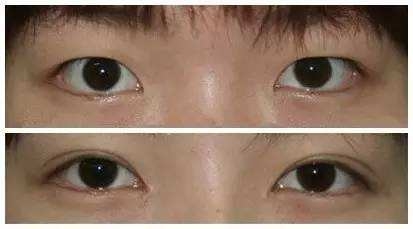 开外眼角手术会影响视力吗
