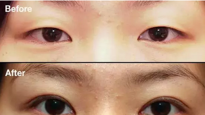开外眼角术前术后效果对比