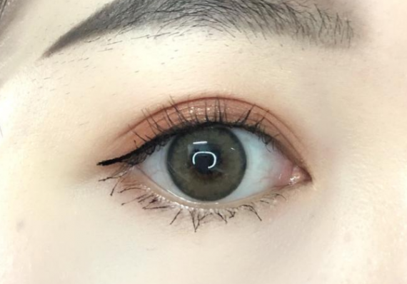 埋线双眼皮手术后遗症有哪些
