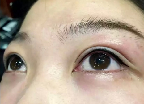祛除眼袋肿吗