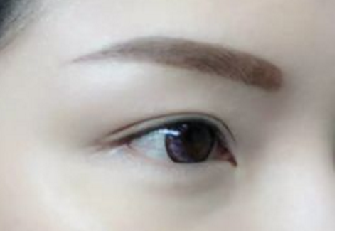 去眼袋黑眼圈肿几天