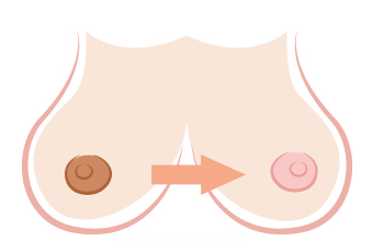 做乳晕漂红整形医院哪里好