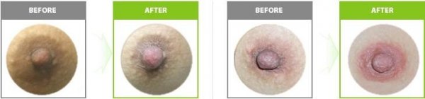 如何令乳晕乳头颜色更粉嫩