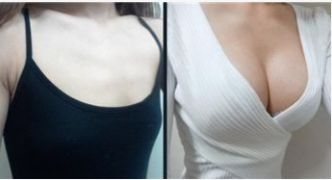 做胸部缩小整形医院哪里好