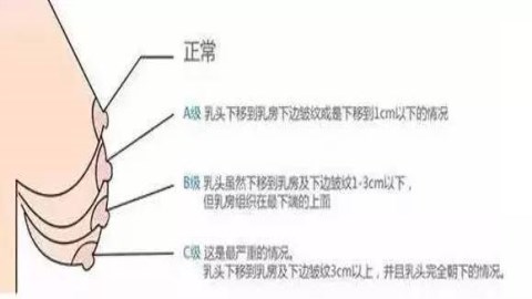 胸部太大而下垂松弛怎么办