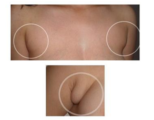 副乳对人体有哪些危害