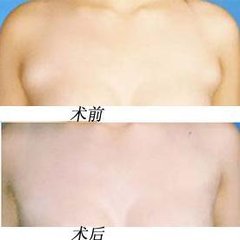 副乳切除的禁忌人群及副作用