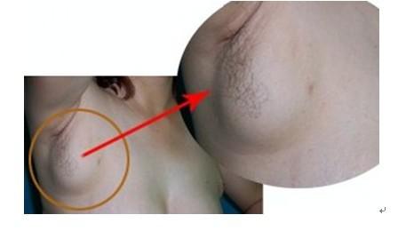 副乳形成的原因，副乳切除注意事项