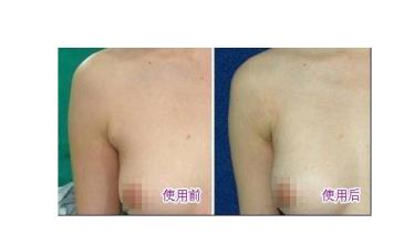 副乳切除手术的切口选择及注意事项