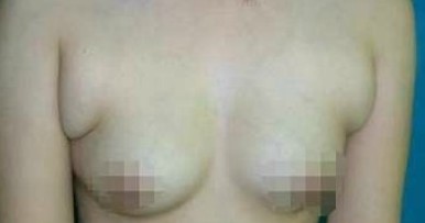 副乳切除手术的后遗症及术后护理