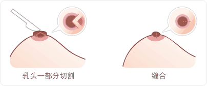 什么医院有乳头缩小术