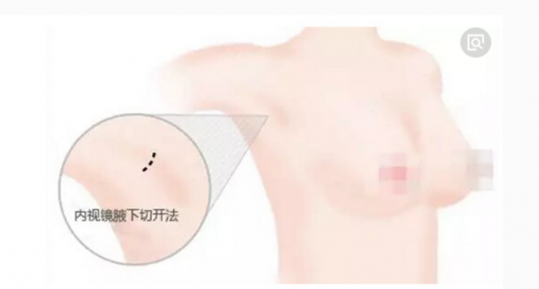 腋下切口要多久能恢复