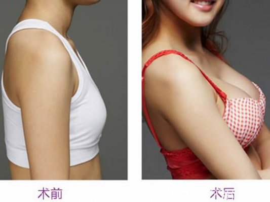 假体隆胸术后必要护理