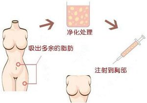 自体脂肪丰胸后胸部出现硬块怎么办?