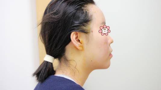 做自体脂肪填充痛吗