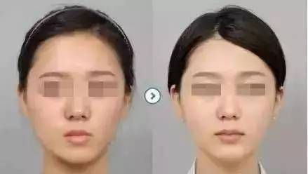 自体脂肪填充后几天消肿