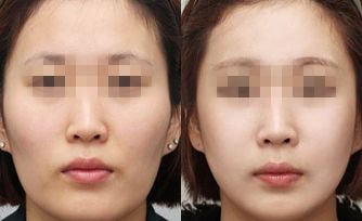 脸部自体脂肪填充面部恢复时间要多久