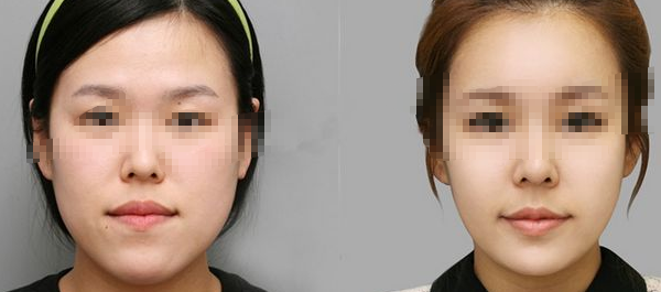 脸部脂肪填充术术后护理怎么做