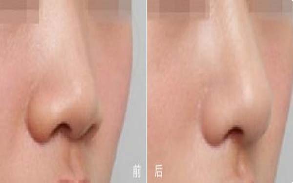 大鼻子整容事宜术