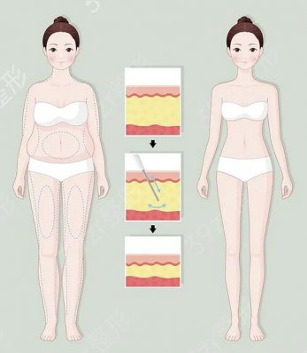 上海伊莱美吸脂怎么样