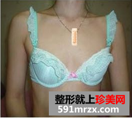 玲玲分享做娜高假体丰胸的真实经历:放心吧,一点也不疼
