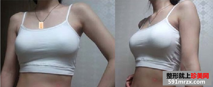 玲玲分享做娜高假体丰胸的真实经历:放心吧,一点也不疼