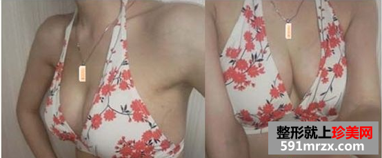 玲玲分享做娜高假体丰胸的真实经历:放心吧,一点也不疼