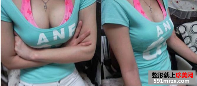 玲玲分享做娜高假体丰胸的真实经历:放心吧,一点也不疼