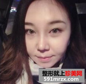 面部吸脂减肥 朋友不再叫我胖子脸