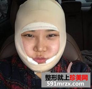 面部吸脂减肥 朋友不再叫我胖子脸