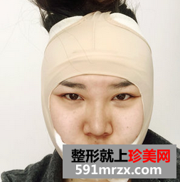 面部吸脂减肥 朋友不再叫我胖子脸
