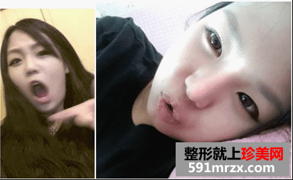 开眼角前后对比图