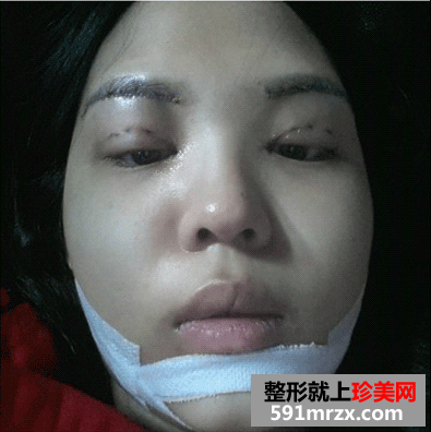 开眼角前后对比图