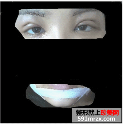 开眼角前后对比图