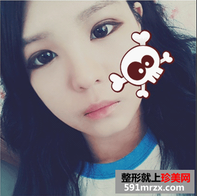 开眼角前后对比图