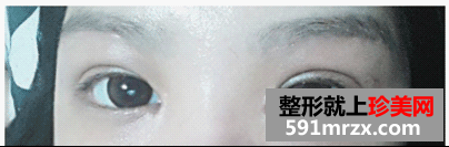 开眼角前后对比图