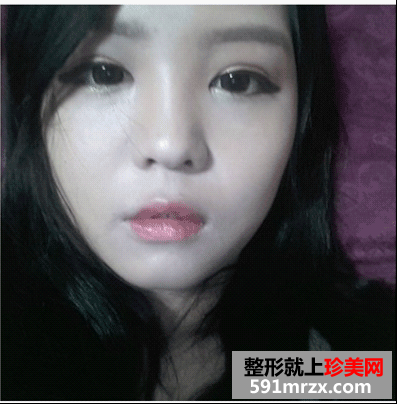 开眼角前后对比图