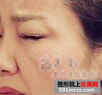 botox去鱼尾纹,返老还童的意思