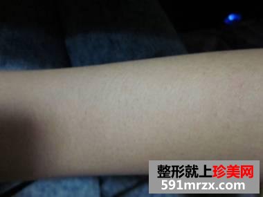 【真人案例】做了个光子脱毛,全身都光溜溜了。