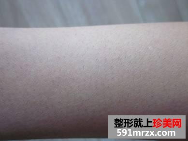 【真人案例】做了个光子脱毛,全身都光溜溜了。
